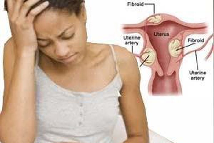 Fibroid