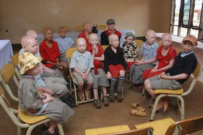 Some albino children