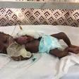 The baby born  with heart outside her chest