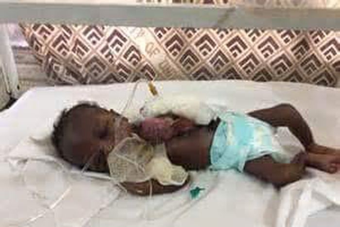 The baby born  with heart outside her chest