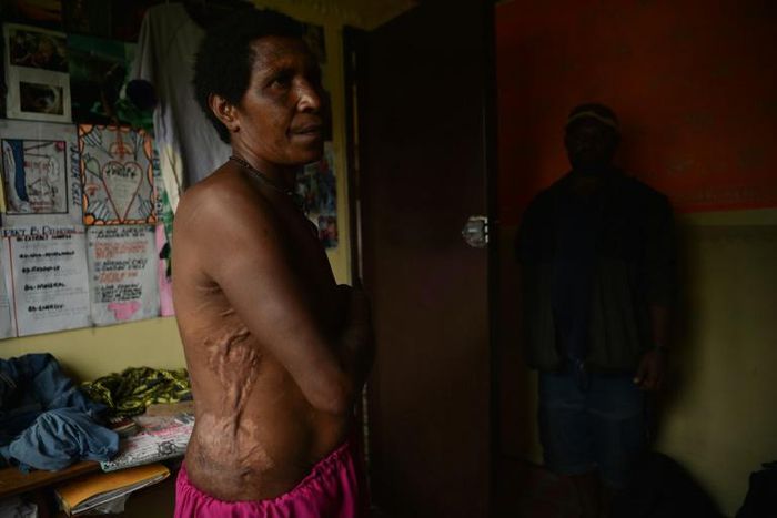 Mother-of-two Rachel shows the scars from wounds inflicted on her in April 2017 when she was accused of sorcery and tortured with hot machetes, spades and rods for a full day by people she knew in the Tsak Valley in the Highlands of Papua New Guinea
