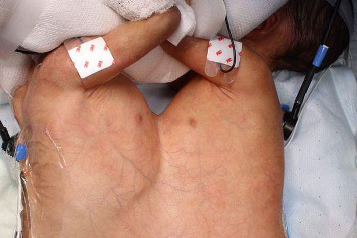 Conjoined Lydia and Maya before their operation in Switzerland