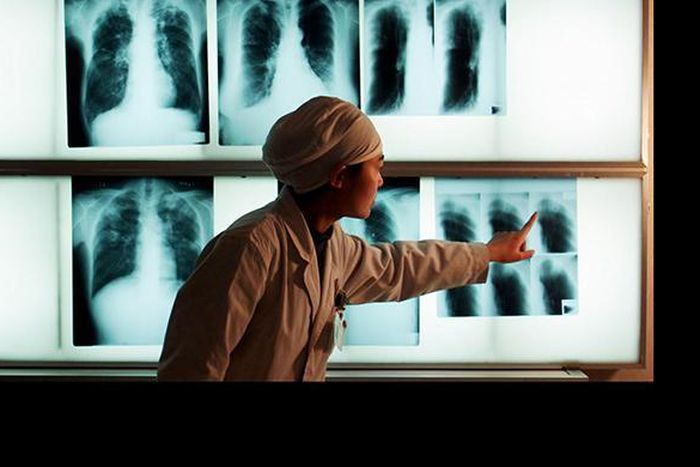 WHO recommends new test, treatment plan for superbug strains of TB