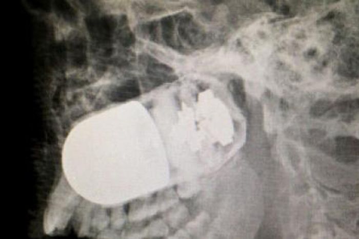 Colombian doctors remove live grenade from soldier’s head