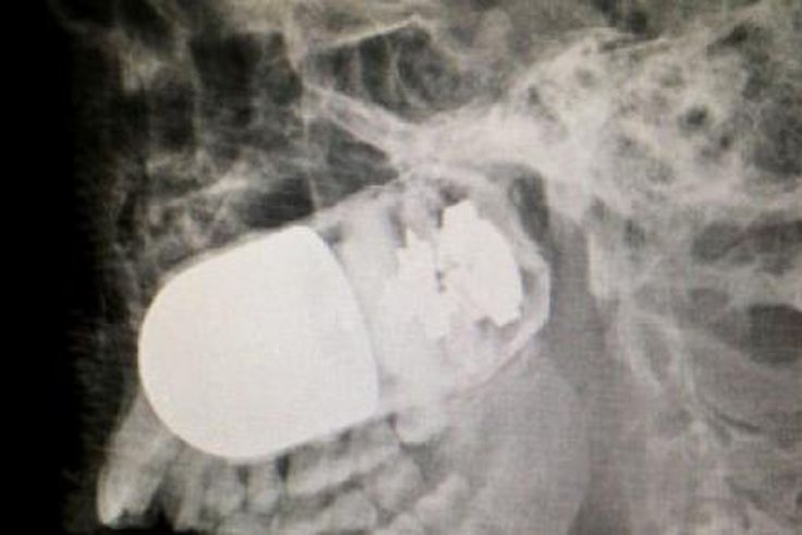 Colombian doctors remove live grenade from soldier’s head