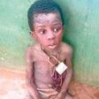 Malnourished boy, rescued by the authorities