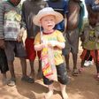 Attacks on albinos in Malawi surge, body parts sold for witchcraft