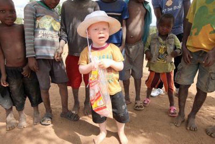 Attacks on albinos in Malawi surge, body parts sold for witchcraft