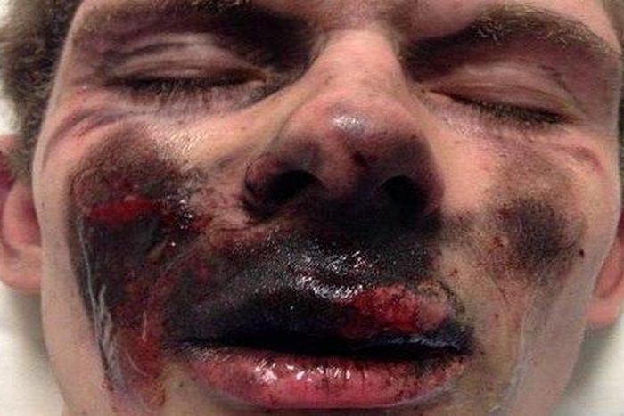 Man severely injured after he tried to smoke an e-cigarette