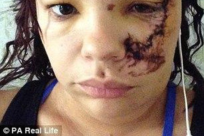 A British student was left scarred for life after a horrific road accident on the first day of a trip of a lifetime to West Africa