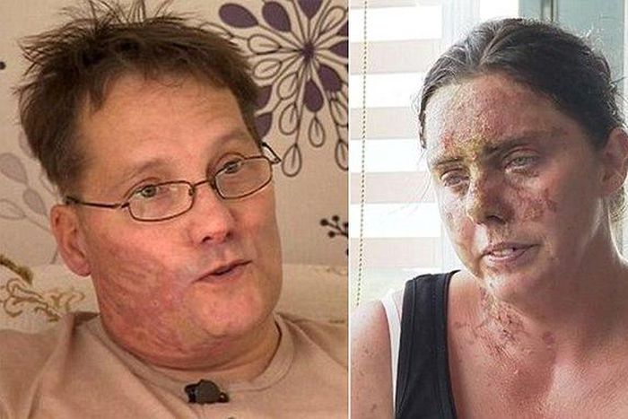 Colombia passes tougher law to tackle high rates of acid attacks