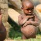 Malnourished child