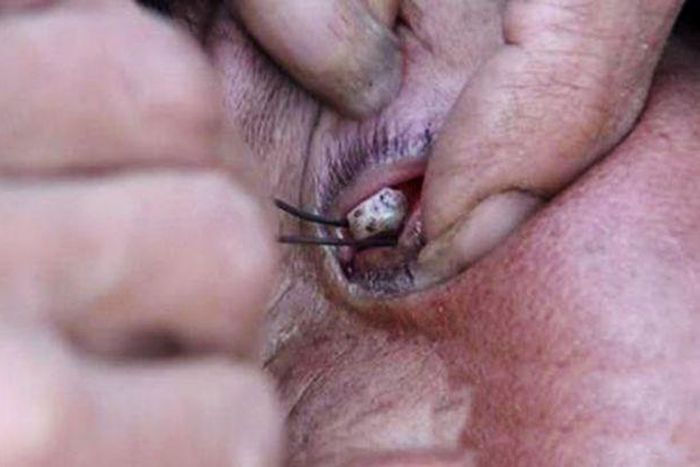 Meet woman who cried tears made of stone for 7 years