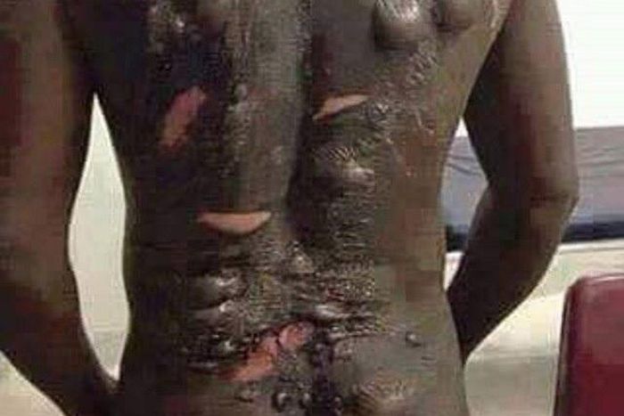 This man was bathed with hot water by his wife