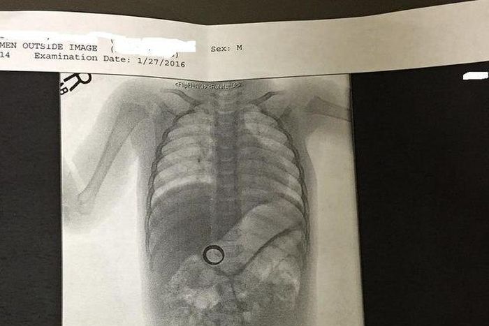 Doctors shocked to find woman's missing wedding ring inside her baby