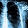 Fight against TB paying off globally, report says