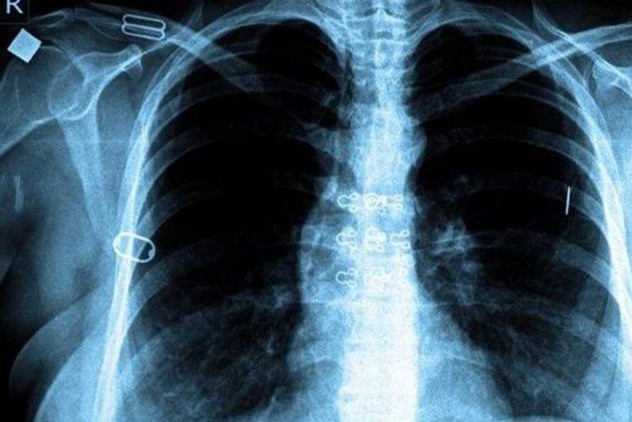 Fight against TB paying off globally, report says