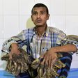 See pictures of Man who has tree roots growing all over his hands