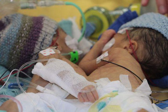 Conjoined Lydia and Maya before their operation in Switzerland