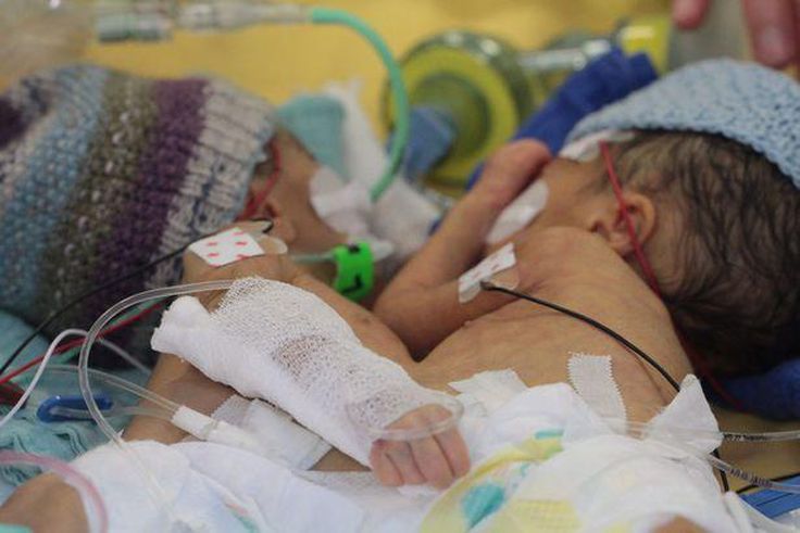 Conjoined Lydia and Maya before their operation in Switzerland