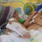Conjoined Lydia and Maya before their operation in Switzerland