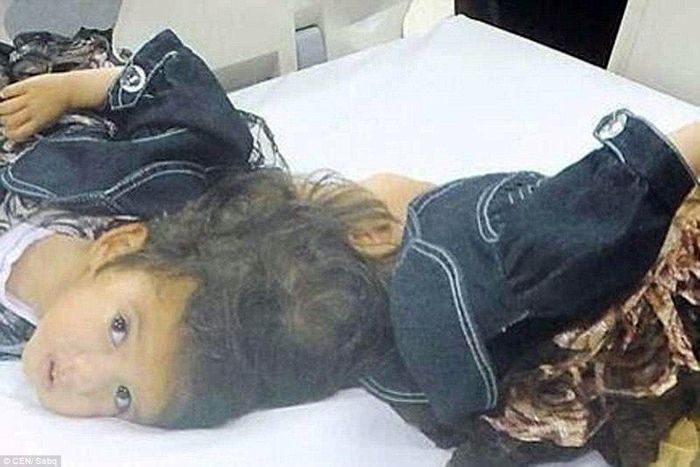 4-yr-old girls joined at the head successfully separated in 10-hour operation