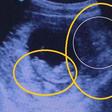Woman's ultra sound photo goes viral after a 'demon' is spotted watching her baby