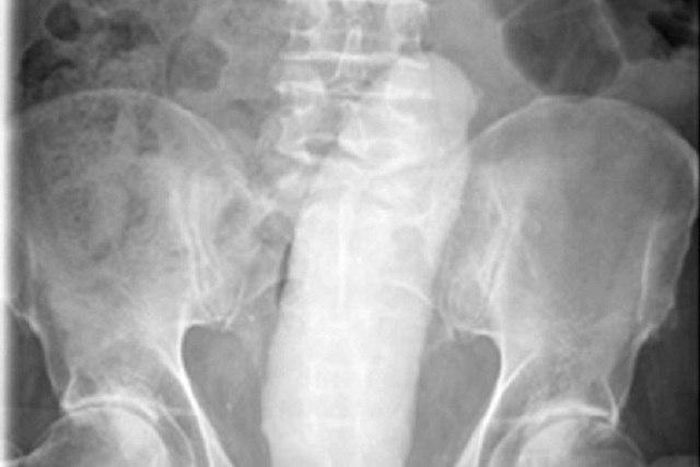 The scanned image of thee dildo in the man's rectum