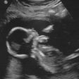 Baby in womb