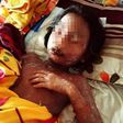 Ho Thi Kieu, 11 year old girl diagnosed with Lyell’s syndrome