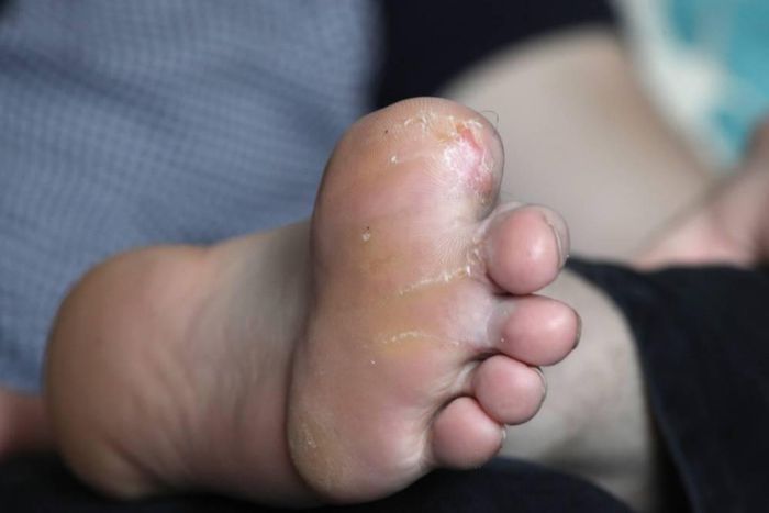 Michael's crushed foot