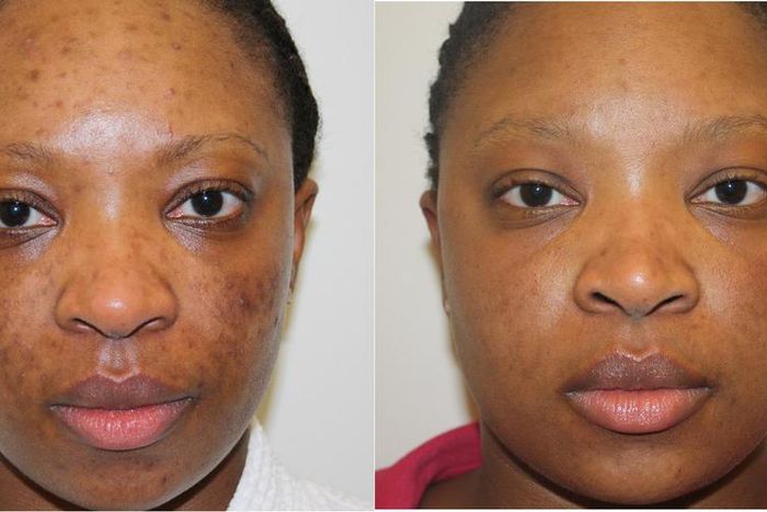 A blemished skin shows improvement after treatment