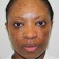 A blemished skin shows improvement after treatment