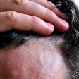 Dandruff is usually caused by dry scalp