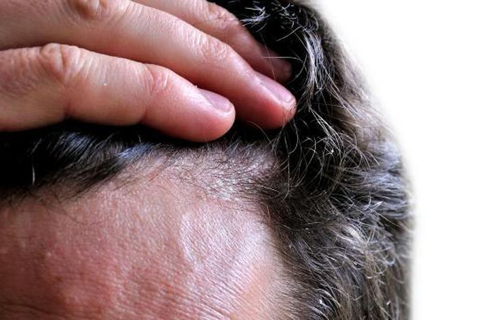 Dandruff is usually caused by dry scalp