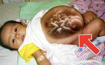 baby-born-pregnant-with-twins
