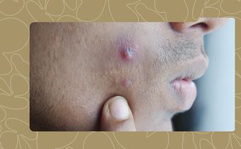 5 Things Making Your Pimples Worse Daily (And What to Use Instead)