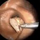 Bug removed from ear