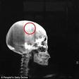 A Chinese woman who has always had regular headaches was surprised to learn that a sharp object was stucked inside her skull.