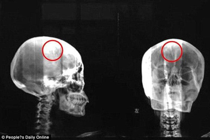A Chinese woman who has always had regular headaches was surprised to learn that a sharp object was stucked inside her skull.