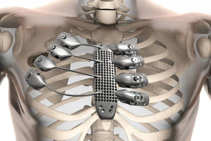 3D imagery showing the titanium rib cage in the patients body