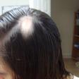 Hairdresser, Ellie Baker, starts to go bald fro stress a few weeks to her wedding day
