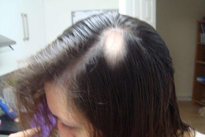 Hairdresser, Ellie Baker, starts to go bald fro stress a few weeks to her wedding day