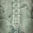 X-ray of prison inmate who attempts to smuggle phone and two chargers by swallowing them