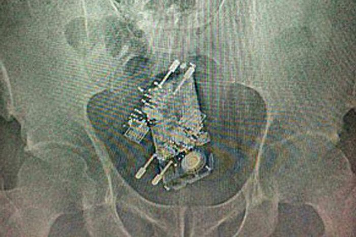 X-ray of prison inmate who attempts to smuggle phone and two chargers by swallowing them