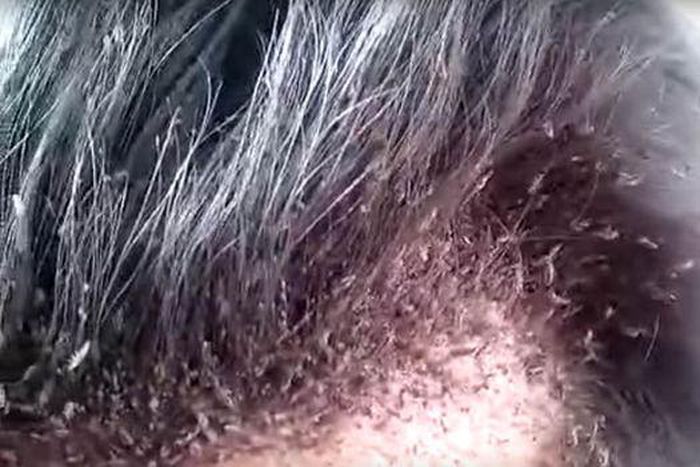 Meet strange man with thousands of Lice on his scalp and hair