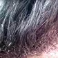 Meet strange man with thousands of Lice on his scalp and hair