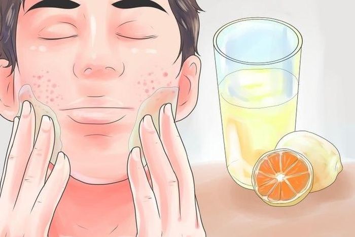 How to get rid of pimples