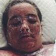29-yr-old Sarah Cole sustained burns over 98 percent of her body after bathing with warm water mixed with bleach in a bid to get rid of exzema