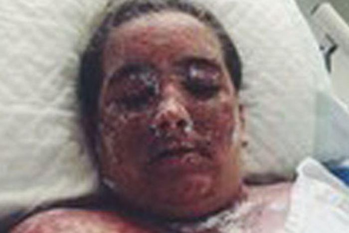 29-yr-old Sarah Cole sustained burns over 98 percent of her body after bathing with warm water mixed with bleach in a bid to get rid of exzema